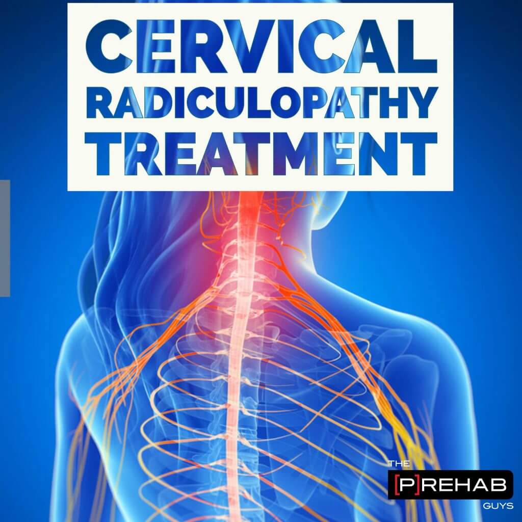 Cervical Radiculopathy Treatment And Assessment | The Prehab Guys