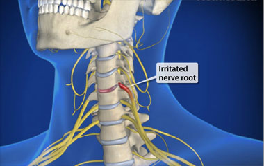 Cervical Radiculopathy (Pinched Nerve in Neck): Symptoms & Treatment