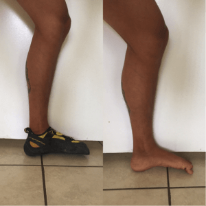 foot ankle inversion rock climbing injury the prehab guys