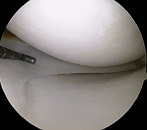 meniscus normal surgery prehab 