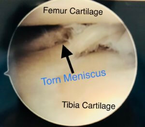 torn meniscus rehab exercises the prehab guys