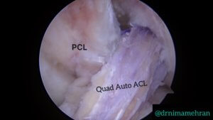 Quadriceps ACL Autograft What is the ACL