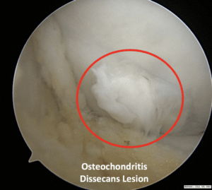 osteochondritis dissecans lesion the prehab guys