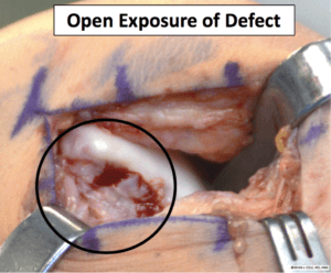 Osteochondral Allograft open exposure of defect the prehab guys