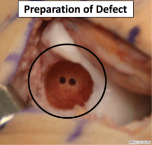 Osteochondral Allograft preparation of defect the prehab guys