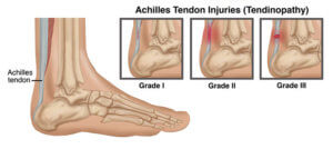 Achilles Tendon injuries how to manage achilles tendon pain the prehab guys