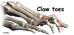 claw toes exercises to improve foot strength the prehab guys 