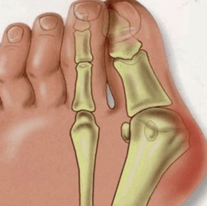 hallux valgus exercises to improve foot pain the prehab guys