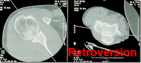 humeral retroversion improve reaching arm behind back the prehab guys