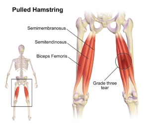Hamstring Strains Prehab