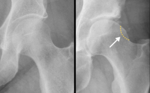 cam deformity versus normal hip anatomy prehab guys