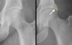 pincer deformity versus normal hip prehab guys