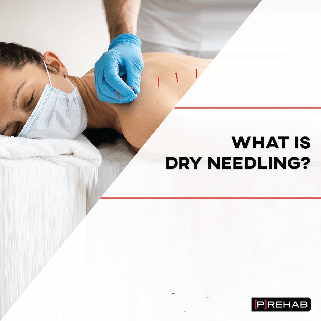what is dry needling prehab guys