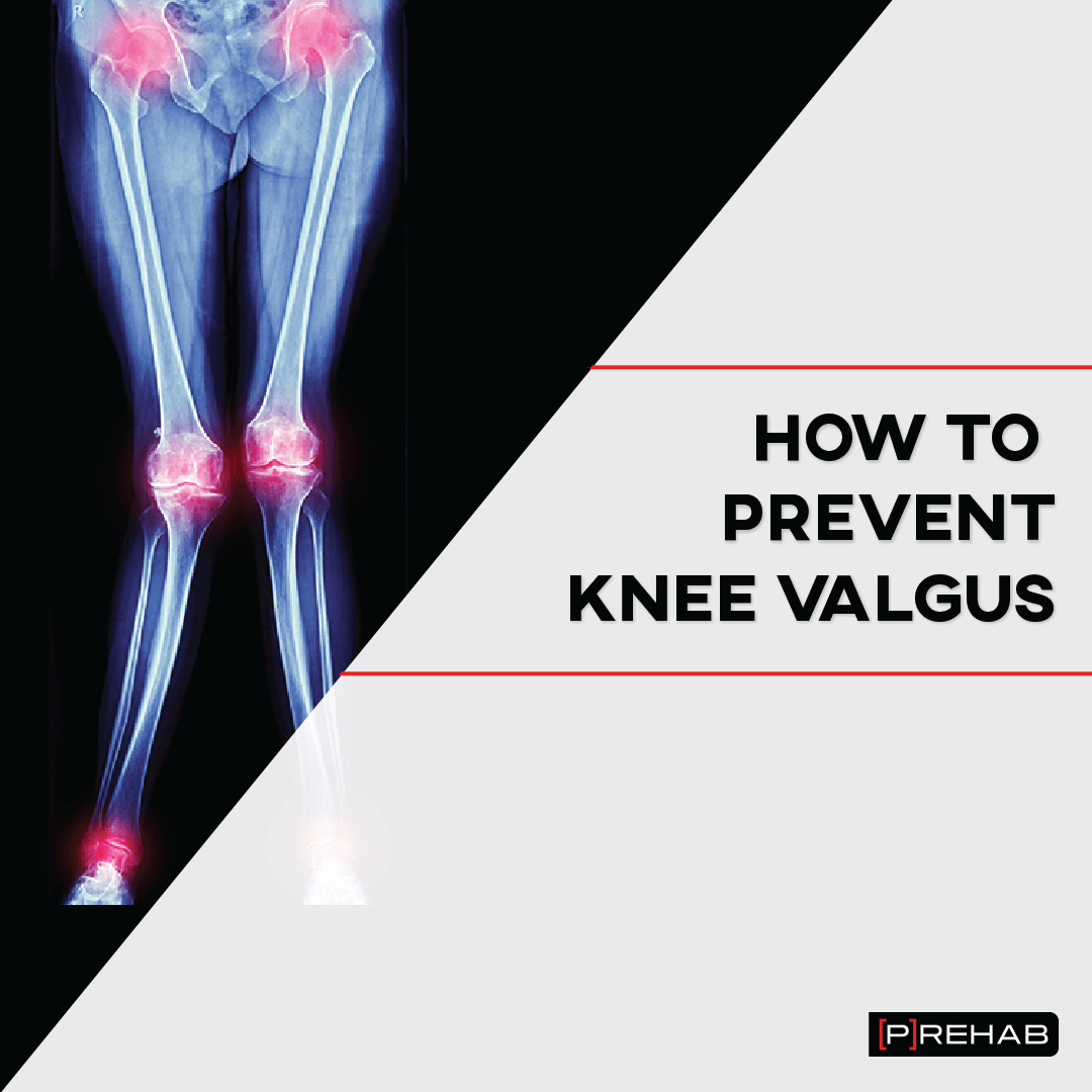 how to prevent knee valgus the prehab guys