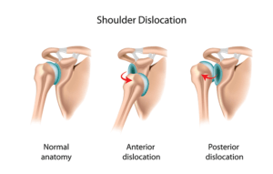 shoulder dislocations instability prehab guys