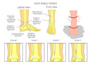 grades of high ankle sprains 