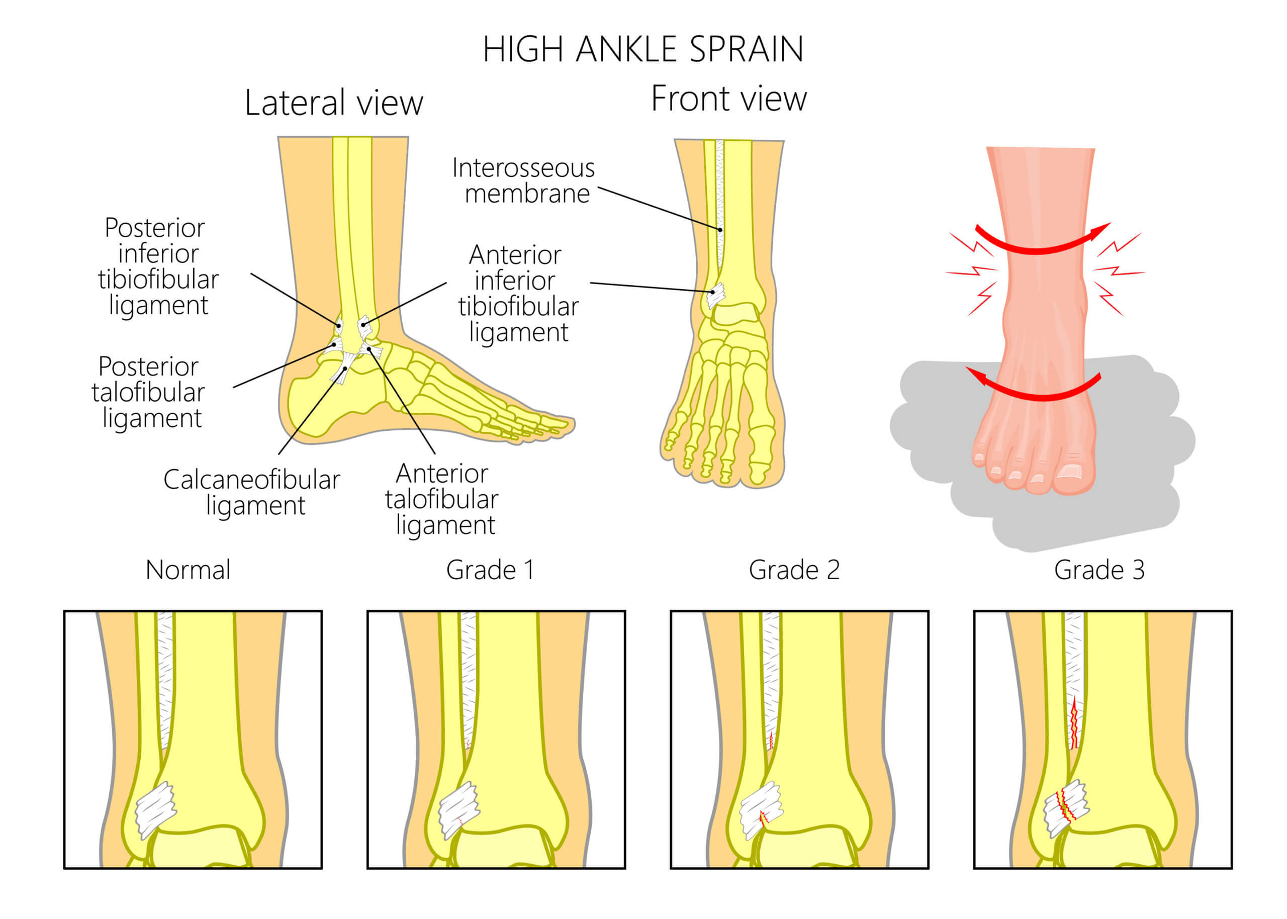 High Ankle Sprain Swelling