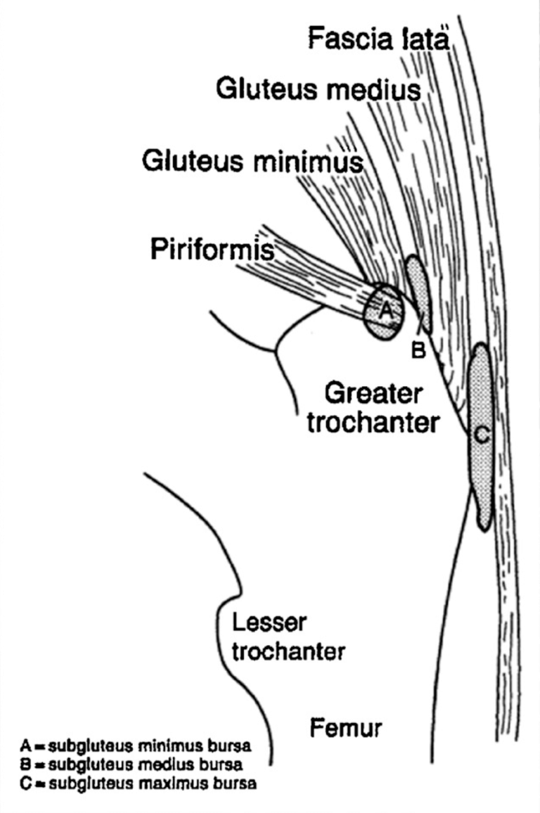 Hip Bursitis Versus Gluteal Tendinopathy – [𝗣]𝗥𝗲𝗵𝗮𝗯