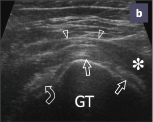 greater trochanteric bursitis ultrasound prehab guys