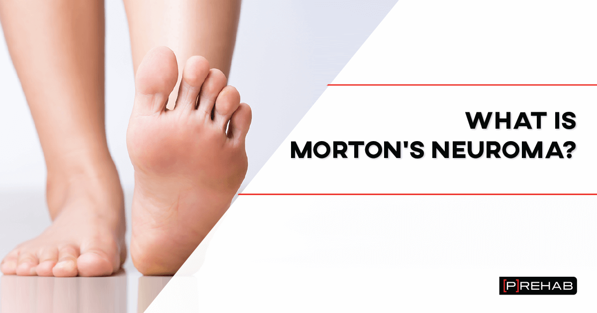 What is Morton’s Neuroma? – [𝗣]𝗥𝗲𝗵𝗮𝗯