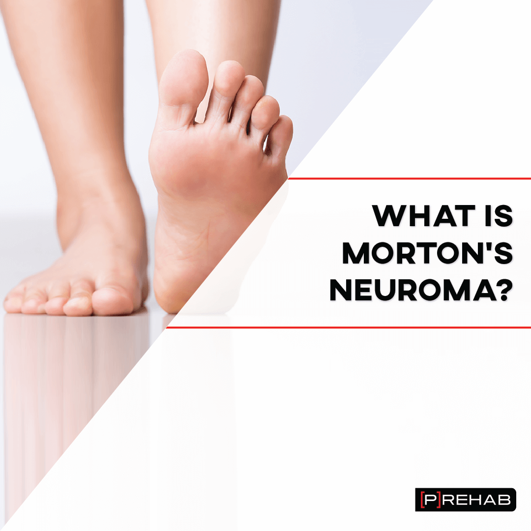 what is mortons neuroma the prehab guys