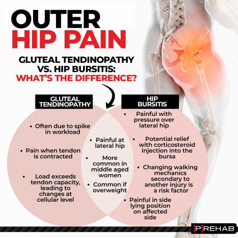 Hip Bursitis Versus Gluteal Tendinopathy [𝗣]𝗥𝗲𝗵𝗮𝗯