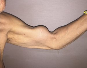 biceps tendon pain exercises biceps tendon rupture popeye deformity the prehab guys