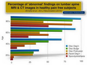percentage of abnormal findings on MRI and CT exercises for disc herniations the prehab guys