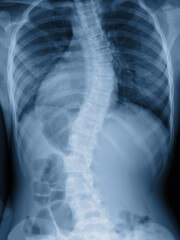 Scoliosis: Causes, Treatment, and Exercise Implications