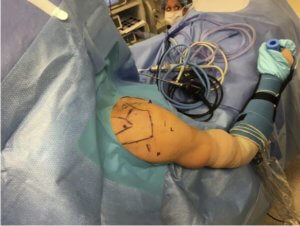 rotator cuff surgery prehab guys