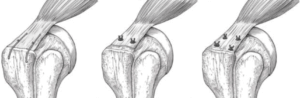 types of rotator cuff repairs prehab guys 