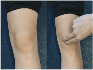 knee plica syndrome prehab guys