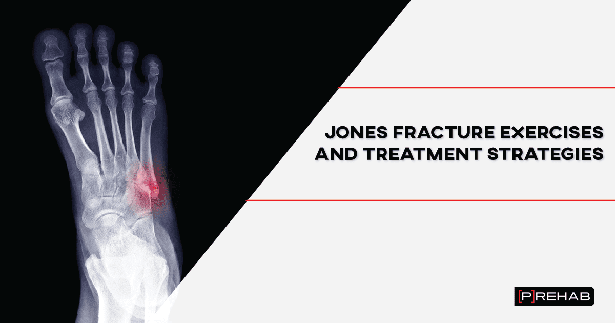 Jones Fracture Exercises and Treatment Strategies | [P]rehab