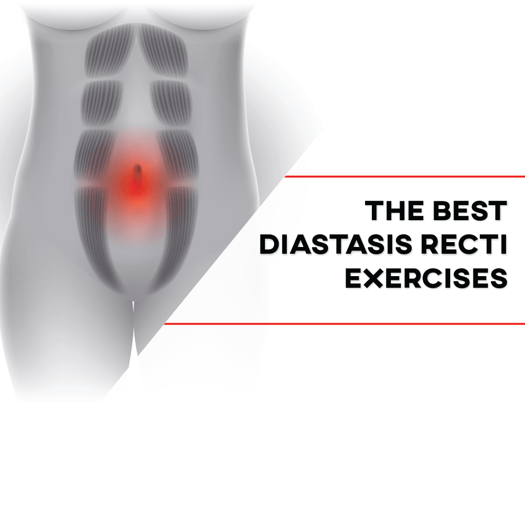 5 Effective Diastasis Recti Exercises 
