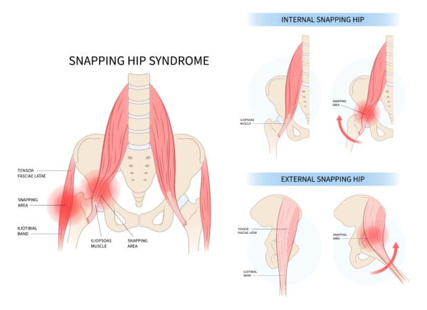 snapping hip syndrome the prehab guys 