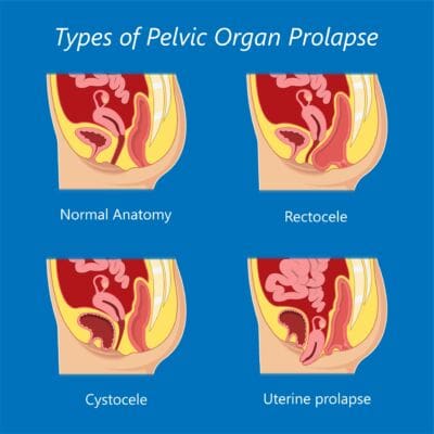 pelvic organ prolapse the prehab guys 