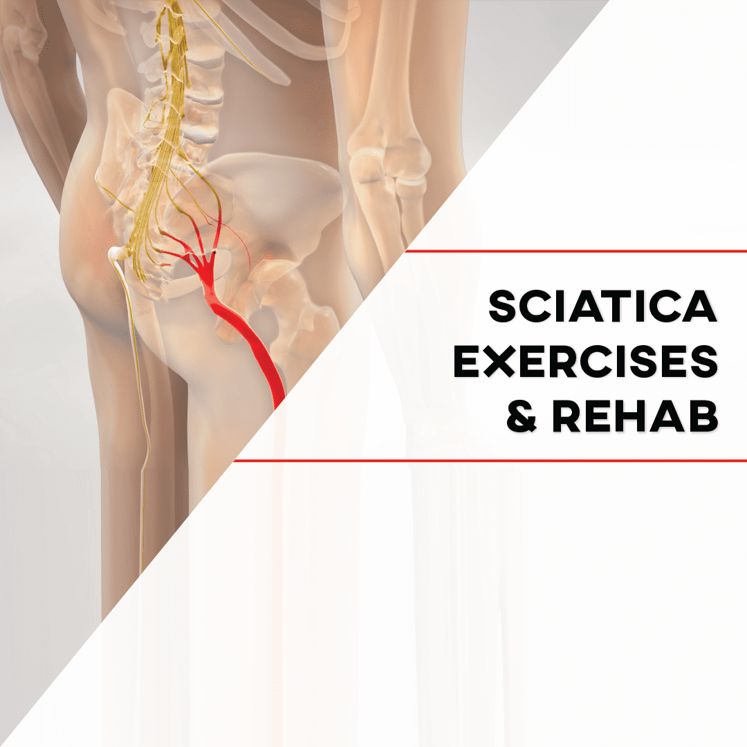 Sciatica: Causes, Symptoms, and Effective Exercises